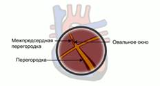 В меж­пред­серд­ной пе­ре­го­род­ке есть за­рос­шее оваль­ное окно, ко­то­рое у за­ро­ды­ша функ­ци­о­ни­ру­ет,  в ре­зуль­та­те чего у него во всех ка­ме­рах серд­ца течет сме­шан­ная кровь