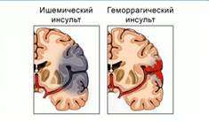 Ин­сульт – это по­вре­жде­ние со­су­дов го­лов­но­го мозга