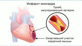 Ин­фаркт миокарда