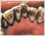 Вли­я­ние ни­ко­ти­на на зуб­ную эмаль