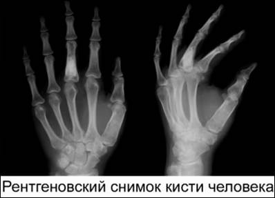 Рентгеновский снимок кисти человека