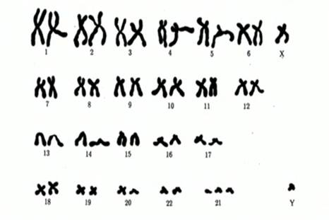 Ка­ри­о­тип муж­чи­ны с син­дро­мом Дауна – три­со­ми­ей 21 хро­мо­со­мы