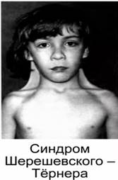 Ре­бе­нок с син­дро­мом Ше­ре­шев­ско­го-Тер­не­ра (ка­ри­о­тип ХО)